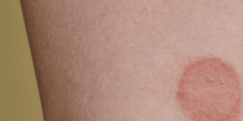 Nummulair eczeem of ringworm (1)